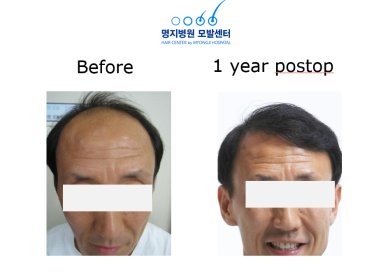 Haartransplantation Ergebnis bei Myongji Hospital – vollere Haarlinie nach 1 Jahr