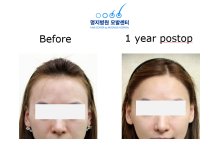 Vorher-nachher-Ergebnis Haartransplantation bei Myongji Hospital – dichtere Haarlinie nach 1 Jahr