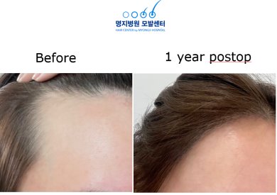 Vorher-nachher-Ergebnis Haartransplantation Myongji Hospital – dichtere Haarlinie nach 1 Jahr