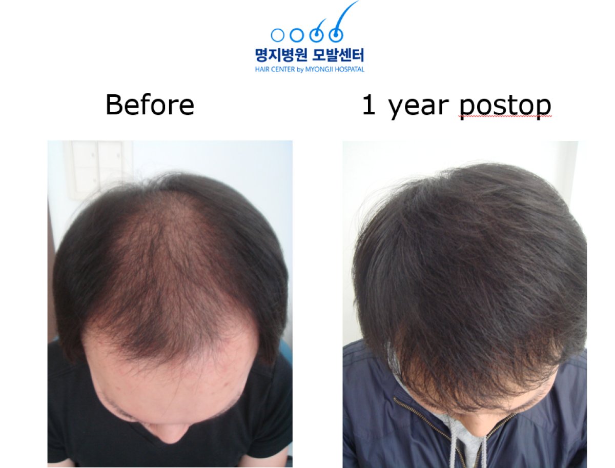 Resultado de trasplante capilar en Myongji Hospital: cabello más denso tras 1 año