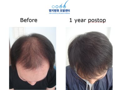 Ergebnis der Haartransplantation in Myongji Hospital – volleres Haar nach 1 Jahr