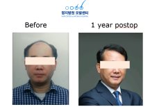 Ergebnis Haartransplantation bei Myongji Hospital – vollere Haarlinie nach 1 Jahr