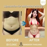 Before and after Vaser liposuction for abdominal etching at ID Clinic Bangkok, visible results