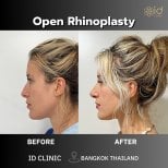 Before and after open rhinoplasty result at ID Clinic Bangkok, nose reshaping improvement