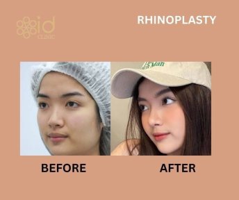 Before and after rhinoplasty results at ID Clinic Bangkok, nose reshaping with natural look