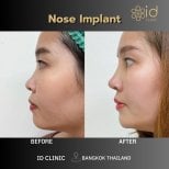 Before and after nose implant results at ID Clinic Bangkok, improved nose profile visible