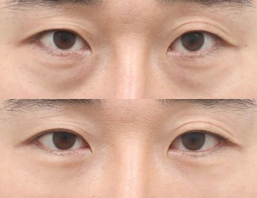 Before and after facial fat transfer at AB Plastic Surgery, reduced under-eye hollows result