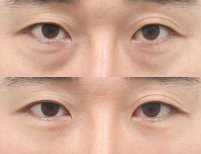 Before and after facial fat transfer at AB Plastic Surgery, reduced under-eye hollows result