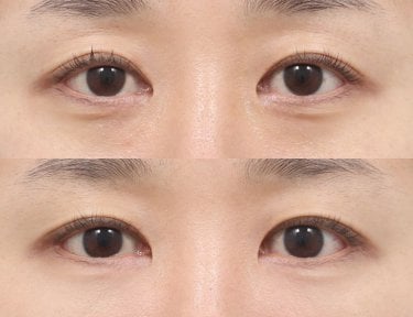 Before and after facial fat transfer at AB Plastic Surgery, under-eye volume improvement result