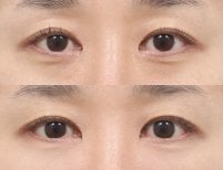 Before and after facial fat transfer at AB Plastic Surgery, under-eye volume improvement result
