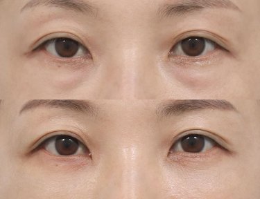 Before and after facial fat transfer at AB Plastic Surgery, reduced under-eye hollows result