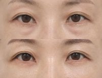 Before and after facial fat transfer at AB Plastic Surgery, reduced under-eye hollows result