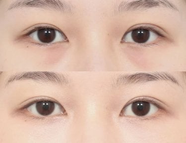 Before and after facial fat transfer at AB Plastic Surgery, under-eye volume restoration result