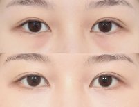 Before and after facial fat transfer at AB Plastic Surgery, under-eye volume restoration result