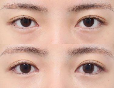 Before and after facial fat transfer at AB Plastic Surgery, under-eye rejuvenation result