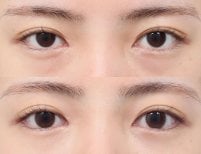 Before and after facial fat transfer at AB Plastic Surgery, under-eye rejuvenation result