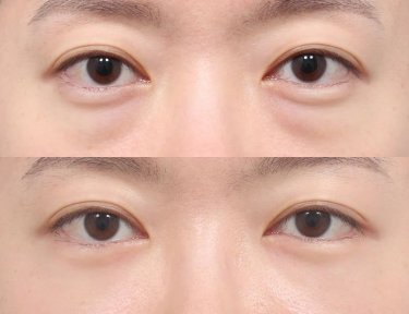 Before and after facial fat transfer at AB Plastic Surgery, under-eye volume restoration result
