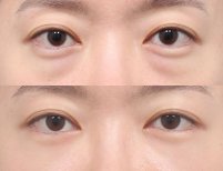 Before and after facial fat transfer at AB Plastic Surgery, under-eye volume restoration result