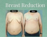 Before and after breast reduction results at DGB Clinic, male chest contour improvement
