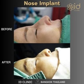 Результаты до и после имплантации носа в ID Clinic Bangkok, улучшенная форма носа