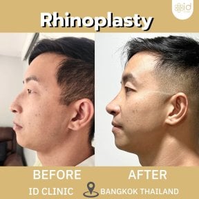 Результаты ринопластики до и после в ID Clinic Bangkok, видимое улучшение формы носа