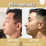 Результаты ринопластики до и после в ID Clinic Bangkok, видимое улучшение формы носа