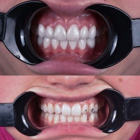 Результаты до и после Hollywood Smile в Dentavie Istanbul Dental Clinic, виниры