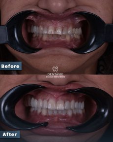 Результат до и после виниров Hollywood Smile в Dentavie Istanbul Dental Clinic