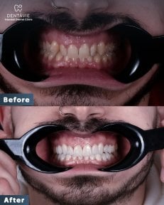 Результаты до и после Hollywood Smile в Dentavie Istanbul Dental Clinic, заметное преображение улыбки