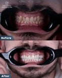 Результаты до и после Hollywood Smile в Dentavie Istanbul Dental Clinic, заметное преображение улыбки