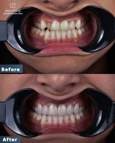 Результаты до и после Hollywood Smile в Dentavie Istanbul Dental Clinic, преображение улыбки