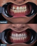 Результаты до и после Hollywood Smile в Dentavie Istanbul Dental Clinic, преображение улыбки