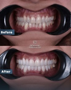 Результаты до и после Hollywood Smile в Dentavie Istanbul Dental Clinic, отбеливание зубов