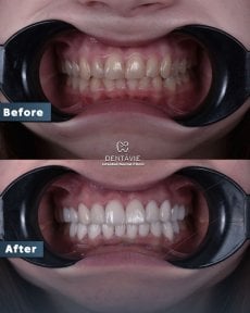 Результаты до и после Hollywood Smile в Dentavie Istanbul Dental Clinic, виниры