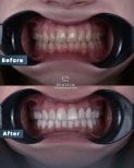 Результаты до и после Hollywood Smile в Dentavie Istanbul Dental Clinic, виниры
