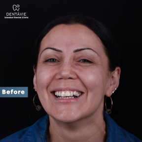 До процедуры Hollywood Smile в Dentavie Istanbul Dental Clinic, видны натуральные зубы