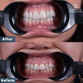 Результаты до и после Hollywood Smile в Dentavie Istanbul Dental Clinic, преображение улыбки