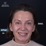 Результат после установки виниров в Dentavie Istanbul Dental Clinic – Голливудская улыбка