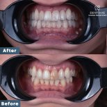 Результаты до и после Hollywood Smile в Dentavie Istanbul Dental Clinic, виниры