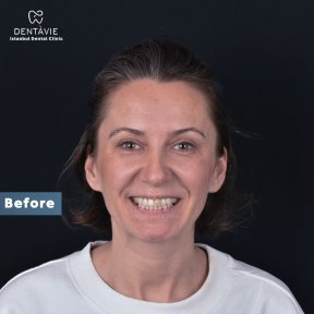 До процедуры Hollywood Smile в Dentavie Istanbul Dental Clinic, видны натуральные зубы