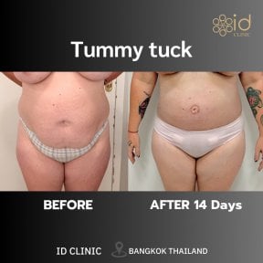 Результати до і після абдомінопластики в ID Clinic Bangkok, помітно плоскіший живіт за 14 днів