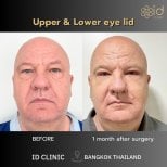 Результати блефаропластики нижніх повік до і після в ID Clinic Bangkok, омолодження очей