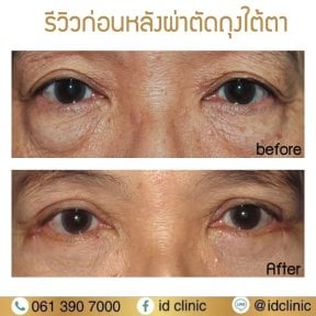 Результати нижньої блефаропластики до і після в ID Clinic Bangkok, зменшення мішків