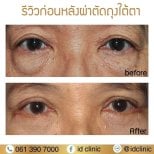 Результати нижньої блефаропластики до і після в ID Clinic Bangkok, зменшення мішків