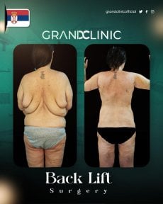 before-after photo body-lift