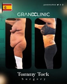 before-after photo body-lift