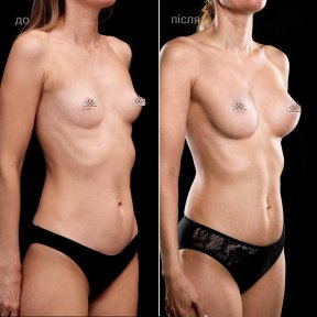before-after photo breast-augmentation