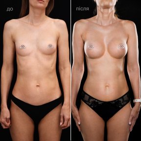 before-after photo breast-augmentation