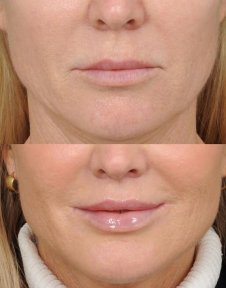 before-after photo platizmoplastika-podtazka-sei