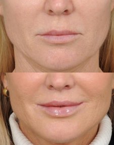 before-after photo platizmoplastika-podtazka-sei